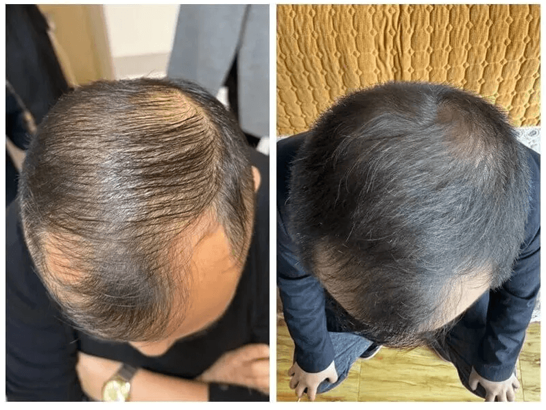 EXOBLOOM&reg; Exosome Scalp Care