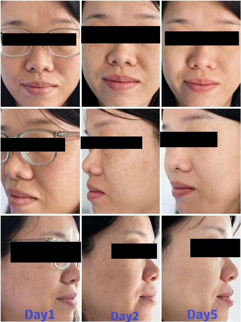 polynucleotide treatment before and after