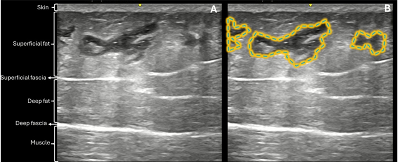 Buttock Augmentation With Hyaluronic Acid