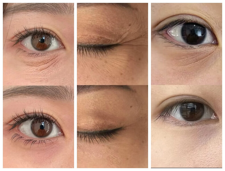 polynucleotide under eyes before and after