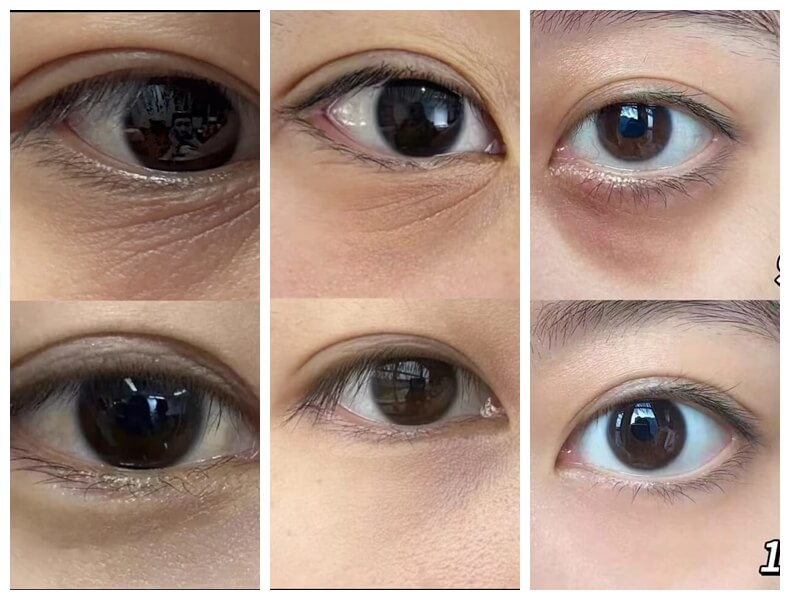 polynucleotides under eyes before and after