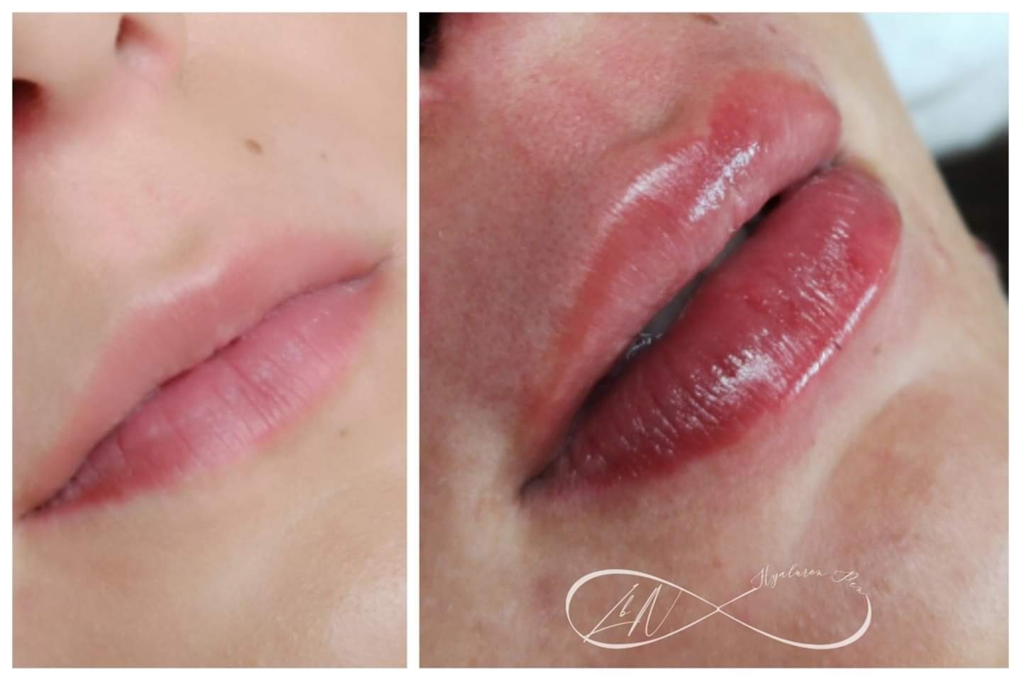 lip filler before and after