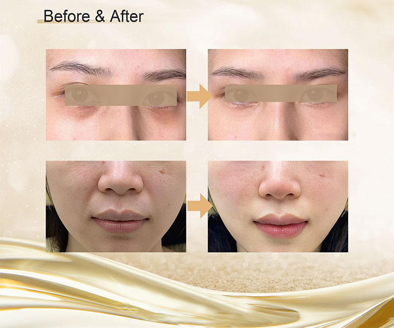 CollaSilk™ Bovine Type 1 Collagen