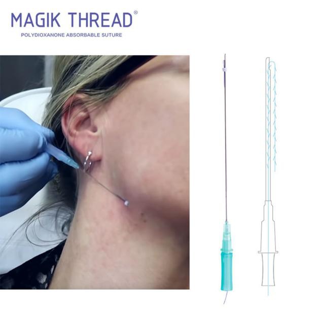 Do You Need a PDO Thread Lift?