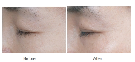 Mesotherapy Under the Eyes Before and after