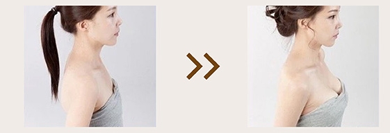 Before and After of Macrolite Breast Filler Injections (1)