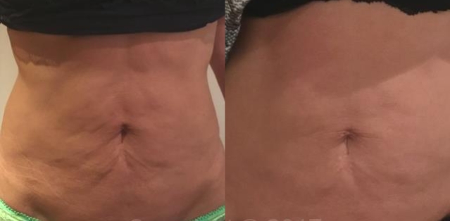Before And After Pdo Thread Lift Abdomen
