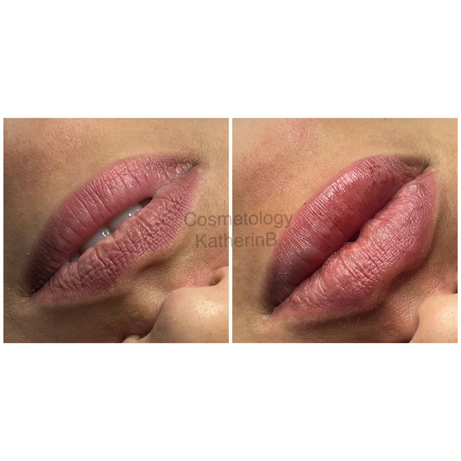 lip filler before and after thin lips