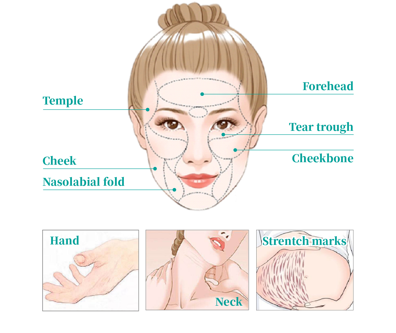Prepare Devolux&reg; PLLA Filler