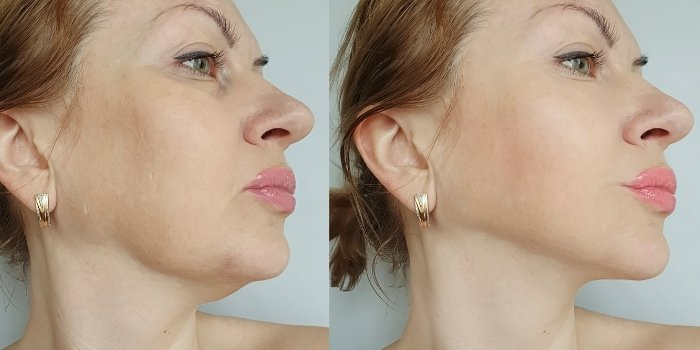 pdo thread lift double chin before and after