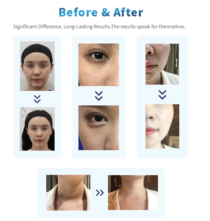 Poly-L-Lactic Acid Biostimulator Filler Injection before and after