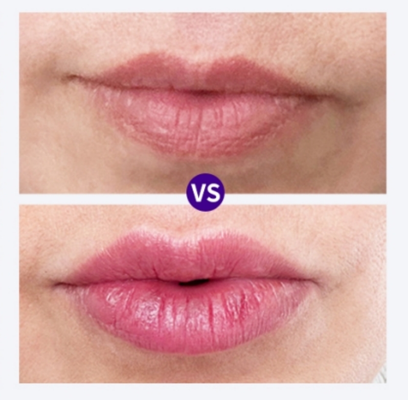 1ml vs 2ml lip filler