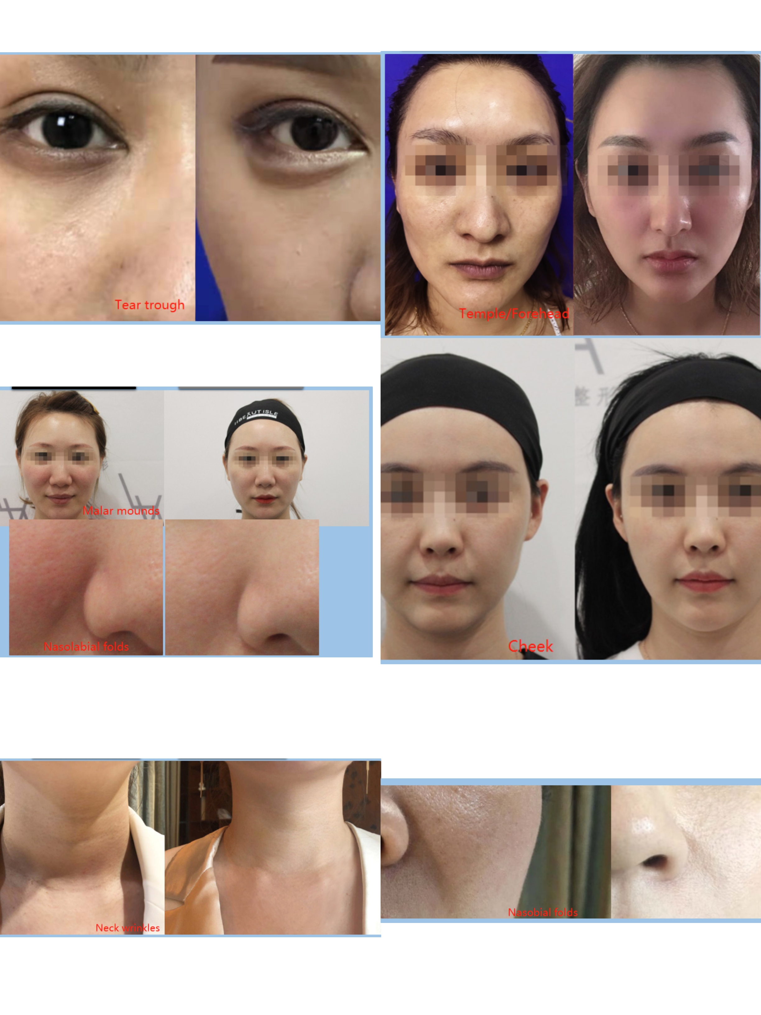 Mesotherapy Plla Collagen Stimulator before and after