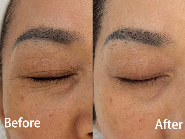 PDRN Eye Treatment Before and After Results (1)