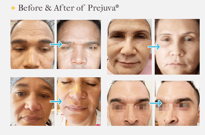 Does Prejuva Hyaluronic Acid Skin Booster Really Work?