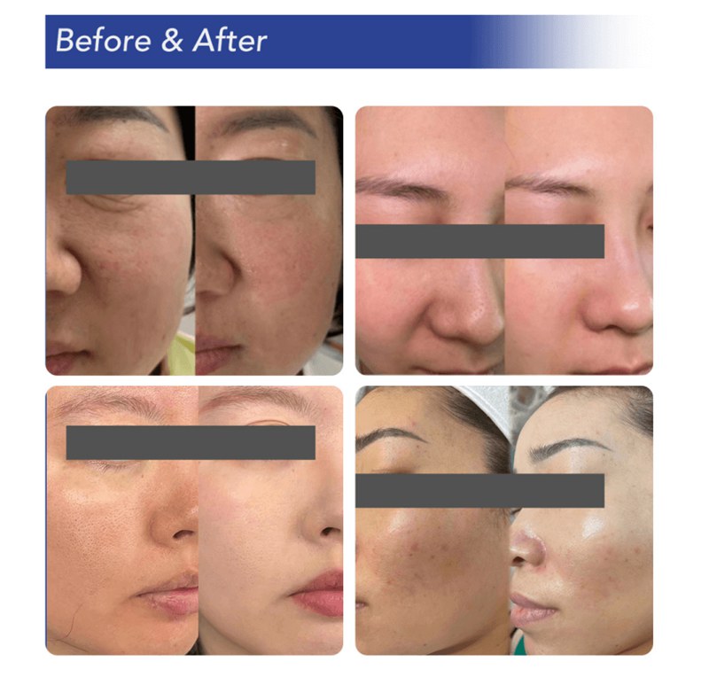 exosomes before and after