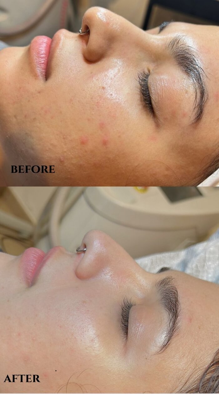 Mesocel&reg; PDRN Injection Before and After – Red Acne Improvement