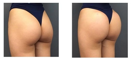 Macrolite hyaluronic acid buttock filler injections before and after