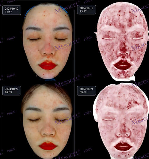Mesocel&reg;-PDRN-Before-and-After-Post-Inflammatory-Redness