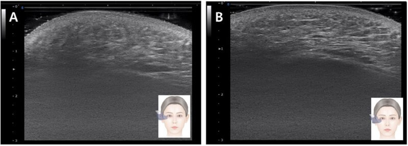 Ultrasound images before and after zygomatic ligament treatment