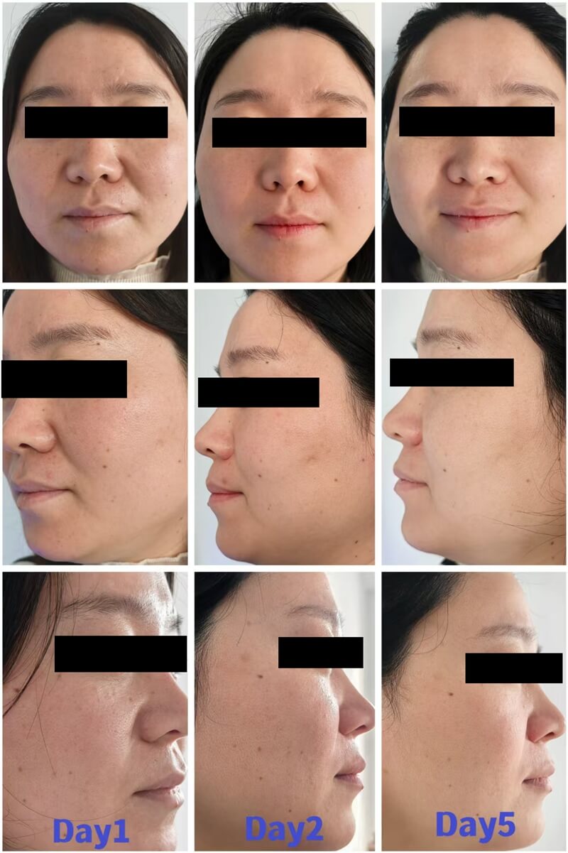exosomes microneedling before and after