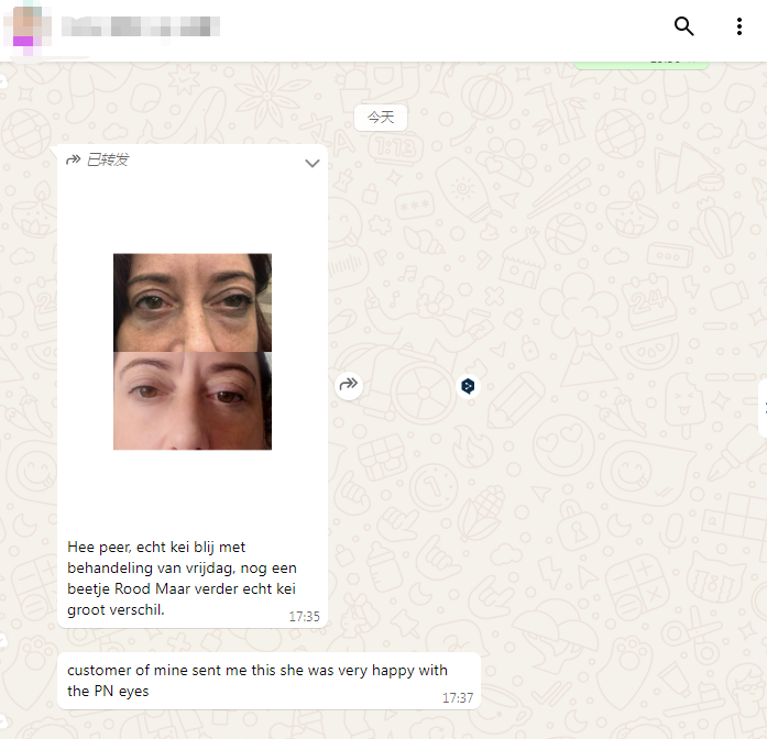 polynucleotides under eyes before and after