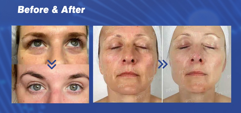 PNPURE NeoBalance polynucleotide skin booster