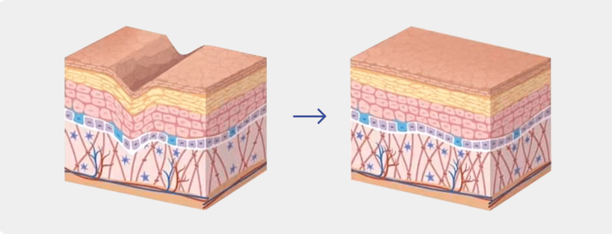 Exosomes with Microneedling vs PRP: The Future of Skin Regeneration