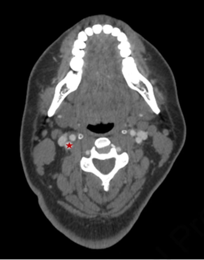 CT showing CaHA embolus in right MCA causing acute infarction