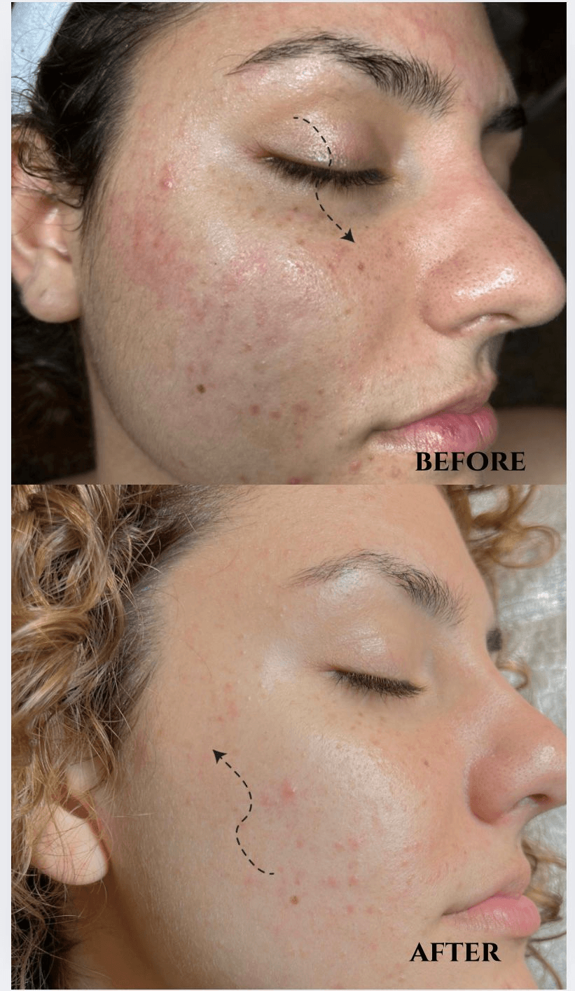 PDRN Treatment Before and After