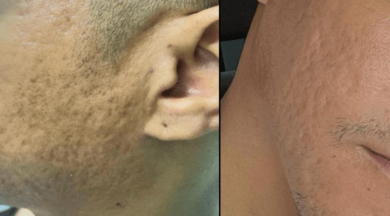 PDRN Treatment Before and After