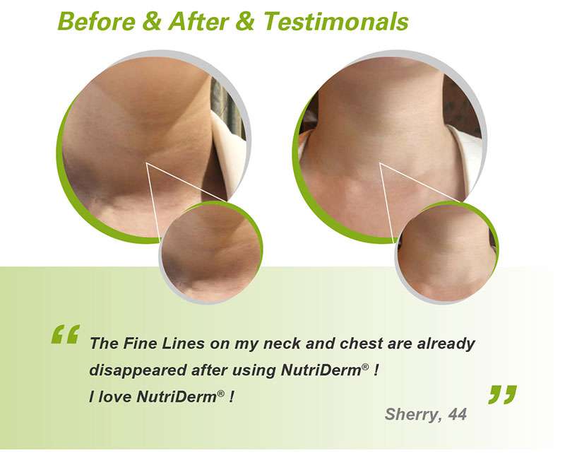 NutriDerm&reg; Hylite best skin booster for neck before and after