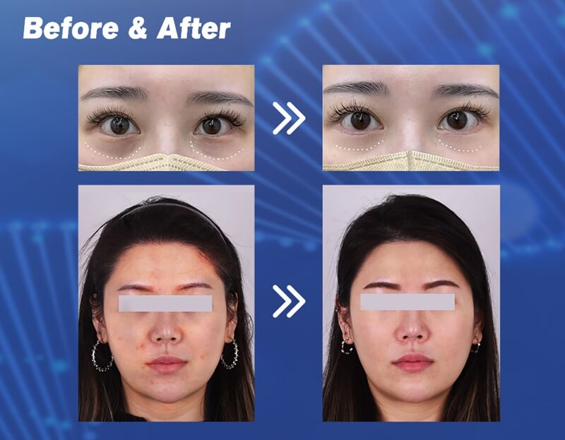 pn skin booster before and after