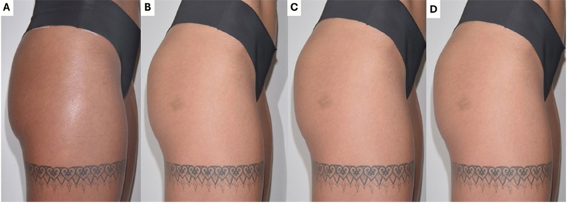hyaluronic acid buttock augmentation