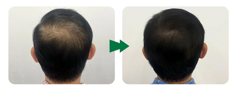 mesotherapy for hair before and after pictures