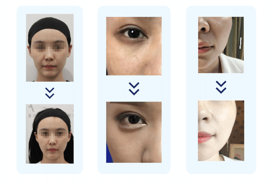 What Results Can You Expect from PLLA Fillers?