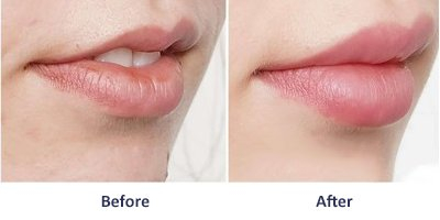 Lip augmentation