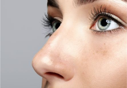 Pdo Thread Facelift for Nose.jpg