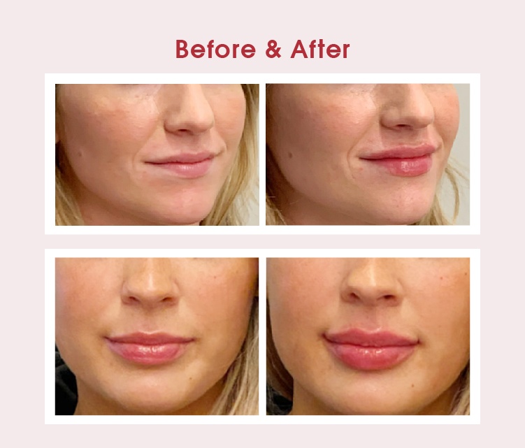 Aqua Secret before and after