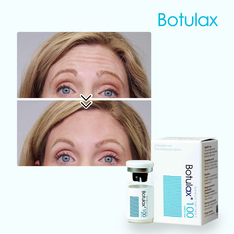 How Much Does 50 Units of Botulinum Toxin Price
