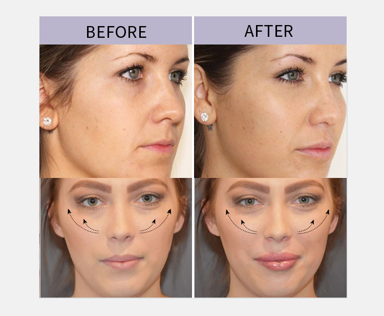 Aqua Secret Filler Intense Hyaluronic Acid Filler Price