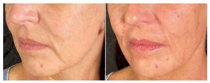 Sotorior Botulinum Toxin for Smile Lines before after