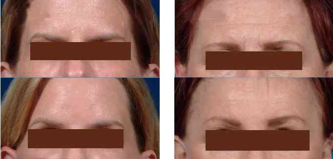 sotorior-botulinum-toxin-eyebrow-lift-(2)