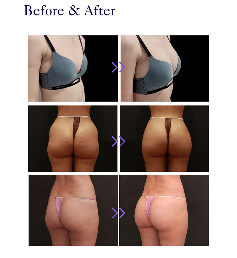 Devolux PLLA Filler For Breast before and after