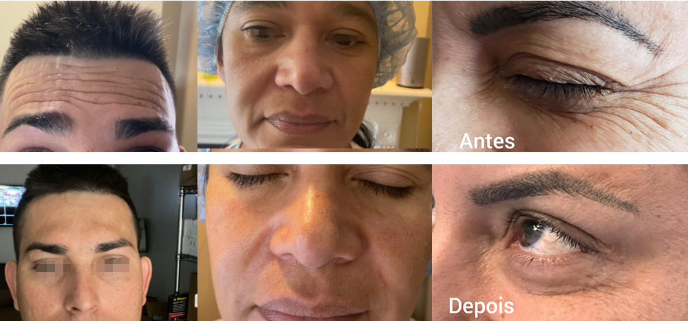 NABOTA in the USA before and after