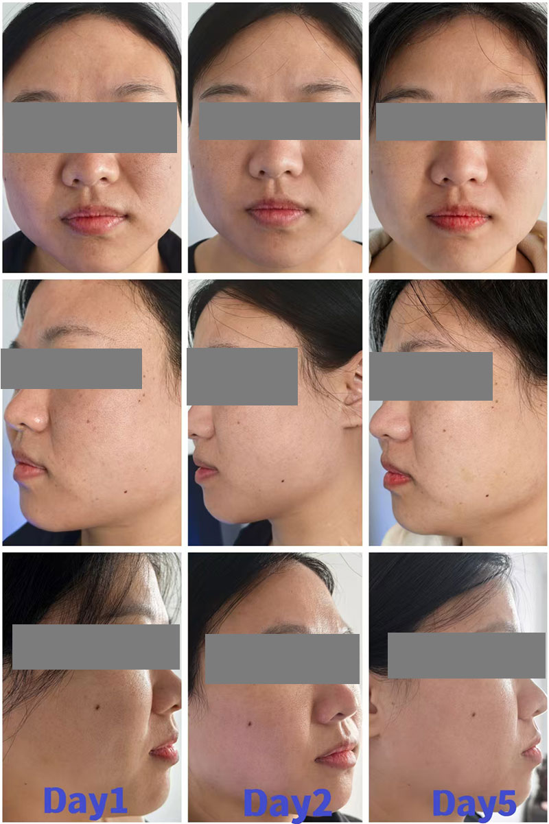 Mesocel Mesotherapy Before And After