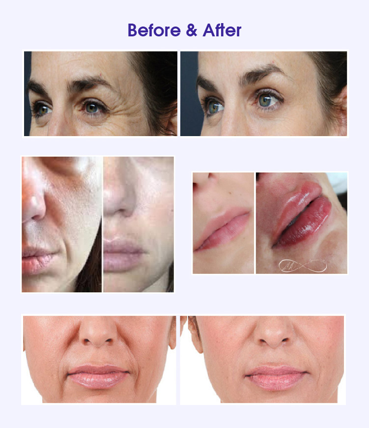 best face filler