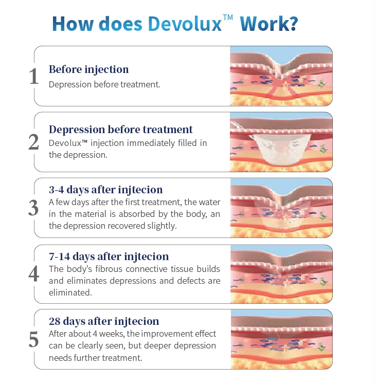 how Poly-L-Lactic Acid Biostimulator Filler Injection work