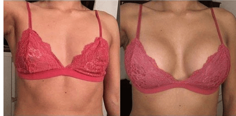 Macrolite breast filler before & after (2)