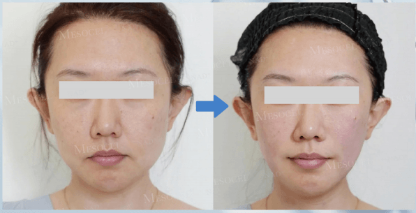 Facial Mesotherapy